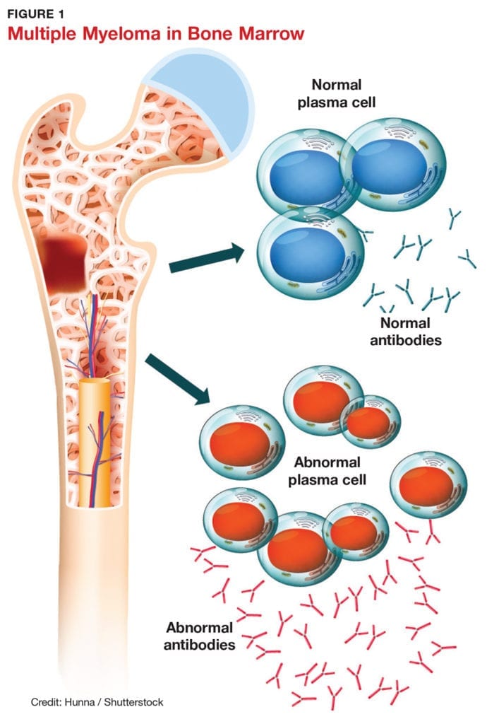 Multiple myeloma 2jpg