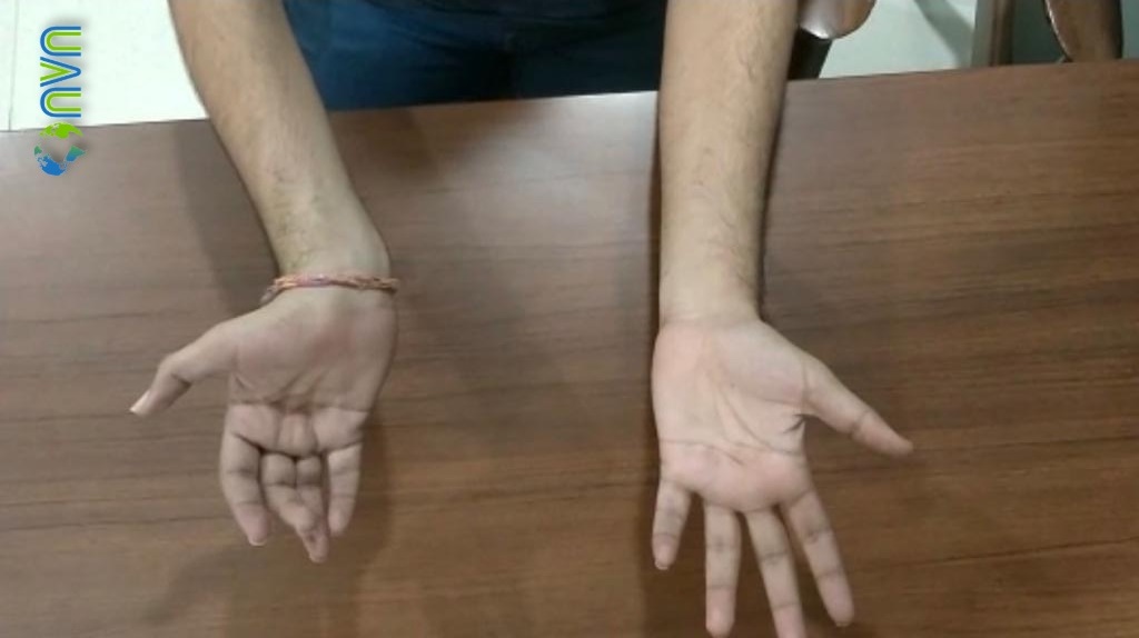 Wasting and weakness of the right hand with thinning of right forearm in a patient with HD (1)