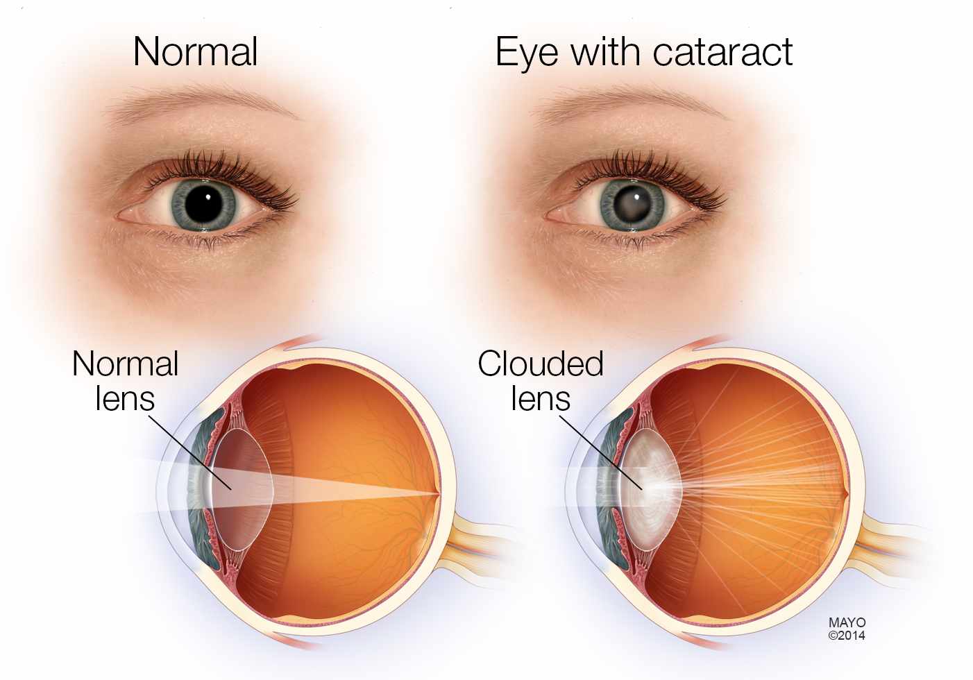 cataract eye 1