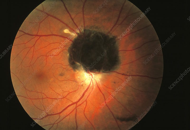 eye tumour